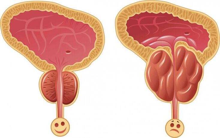 Gesunde Prostata und Prostatitis