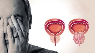 Ursachen der Prostatitis bei Männern